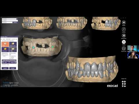Encerado dental digital con exocad