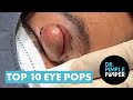 Most Cringeworthy Eye Pops! The Best Eye Pops! Picked By Dr Pimple Popper