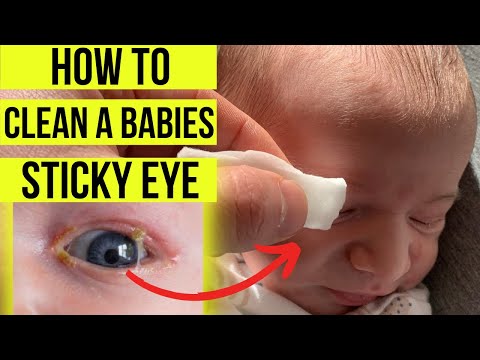How to treat a STICKY EYE in babies (including eye-lid hygiene cleaning & tear duct massage)