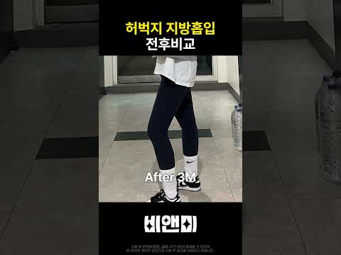 리얼후기-허벅지지방흡입