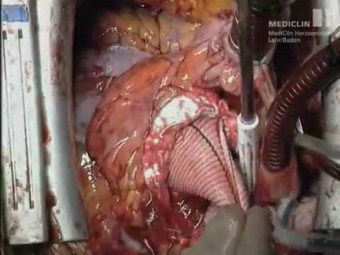 Gelenkschmerzen Lymphknoten Erguss im Sprunggelenk