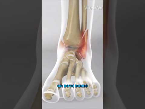 Ankle Fracture Surgery (3D Animation)