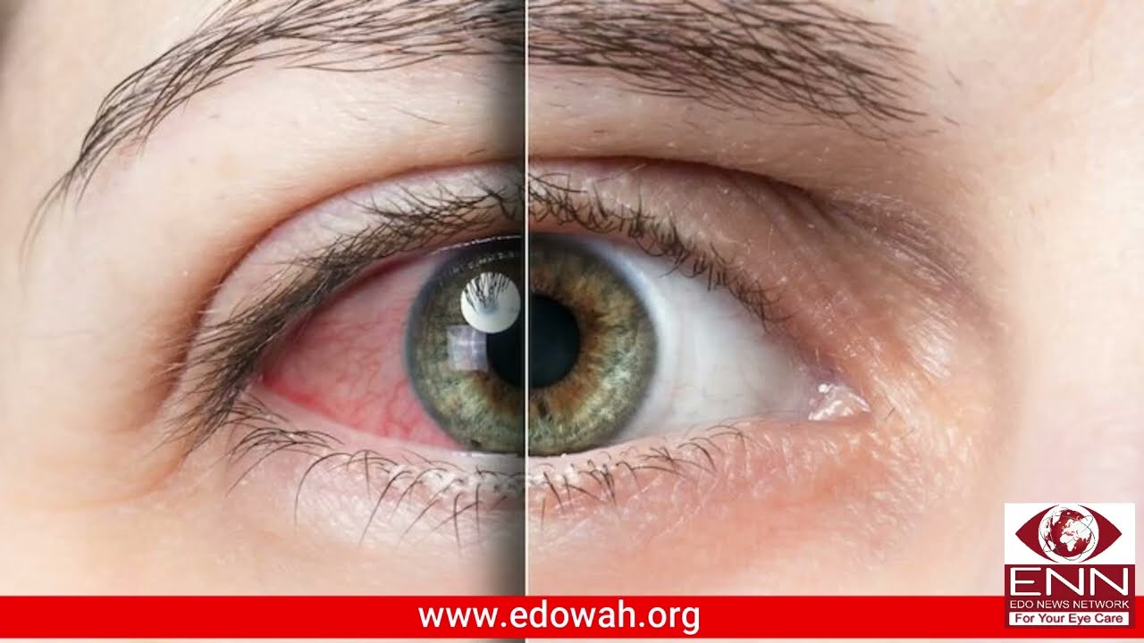 Dry Eyes in Summer | Natural remedies | #Dry Eyes treatment | Dr. Iqra  #EdoEyeHospital #wahcantt