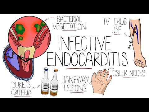 Infective Endocarditis (With Duke Criteria & Pathophysiology)