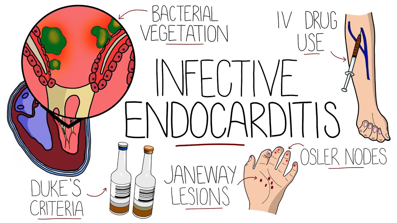 Understanding Infective Endocarditis: Causes, Symptoms, and Treatment ...