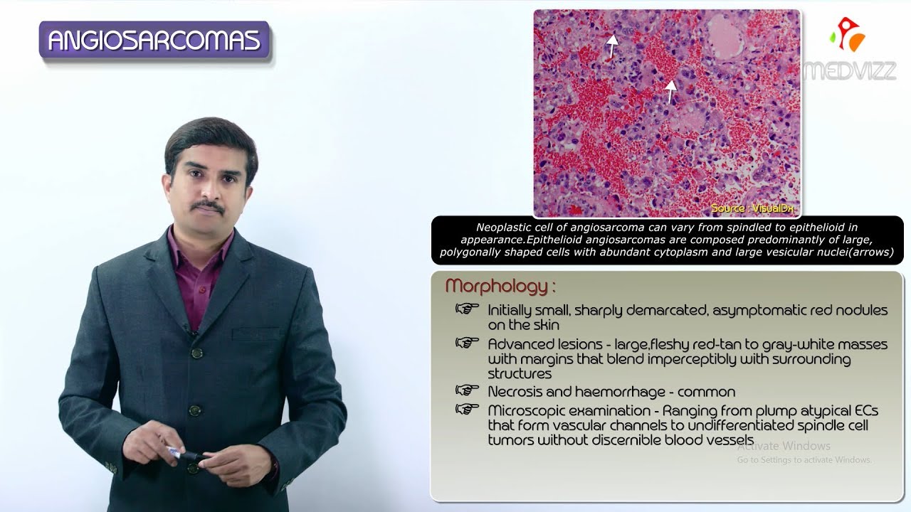 Vascular tumors - Angiosarcoma - Definition, Epidemiology, Pathology, Diagnosis and treatment - YouTube