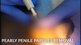 FORDYCE SPOTS + PENILE PEARLY PAPULES ON THE PENIS GLANDS | REMOVE THE WARTY GROWTHS| DR. JASON EMER