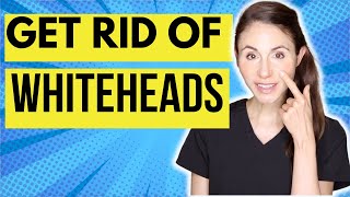 How To Get Rid Of Whiteheads On The Nose