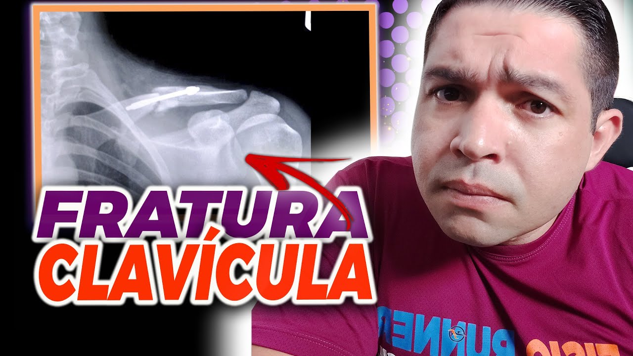 FRATURA DE CLAVÍCULA  tempo de recuperação e Fisioterapia