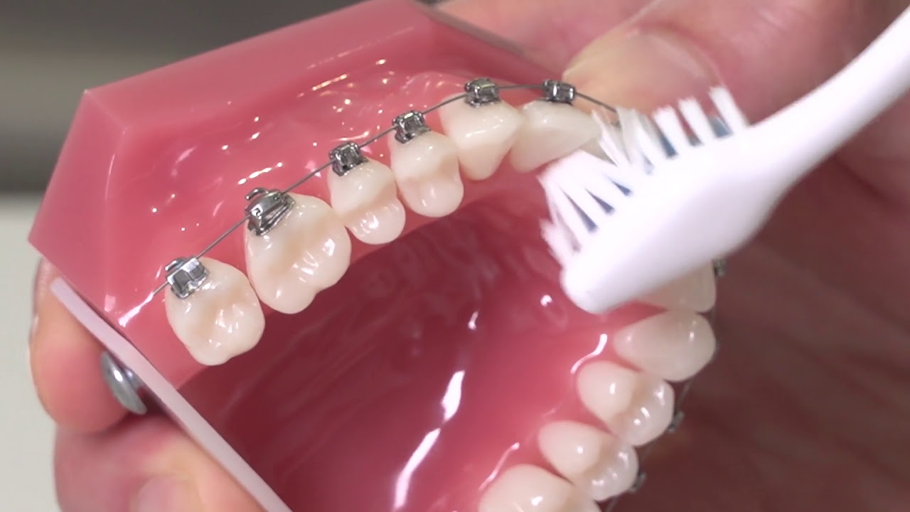 How to Maintain Your Braces