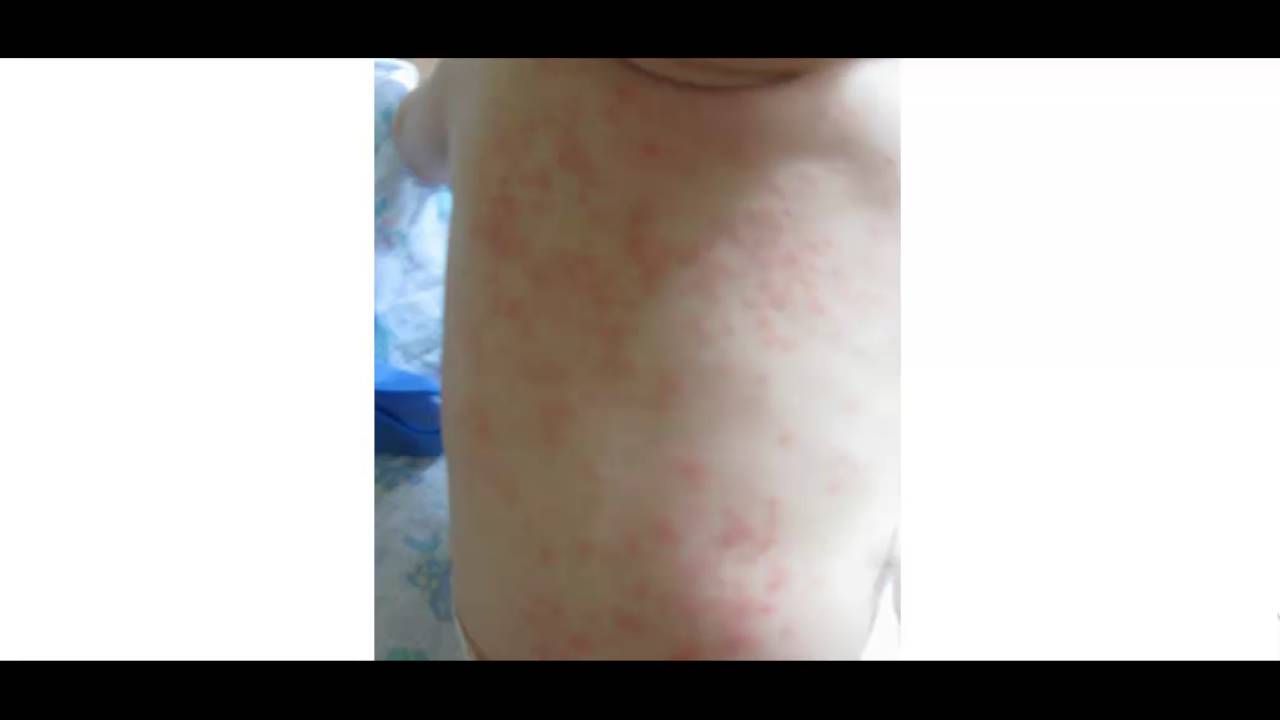 Аллергия на спине у ребенка, у взрослого