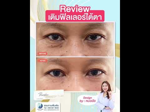 รีวิวโปรแกรมฟิลเลอร์ใต้ตา