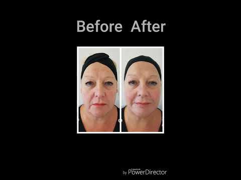 Lumiere MediSpa Dermal Filler Treatment