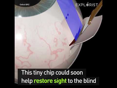 Bionic Eye