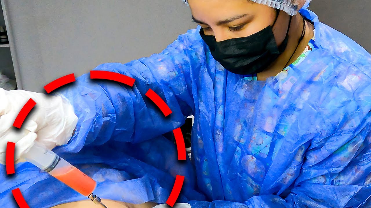 Watch LIPOSUCCION SIN CIRUGIA Como lo hacemos🤔🔥 RESULTADOS con ANTES Y DESPUES🏅 #minilipo #mela #CURSO Now LIPOSUCCION SIN CIRUGIA Como lo hacemos🤔🔥 RESULTADOS con ANTES Y DESPUES🏅 #minilipo #mela #CURSO