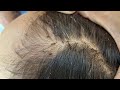 Remove many lice from brown hair - Plucking most of lice from head