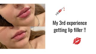 My 3rd experience getting lip filler !! Lilith Cavaliere x