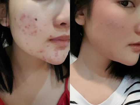 โรค deverzhi หรือโรคสะเก็ดเงิน ความพิการสำหรับกระดูกโรคสะเก็ดเงิน