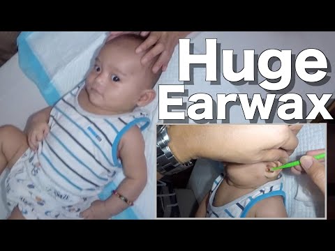 Removing Boy's Huge Earwax | It's Small but Terrible!