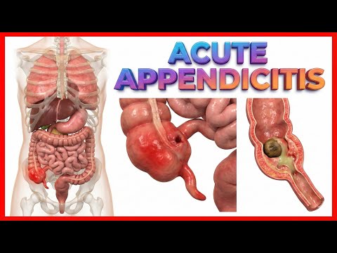Acute appendicitis USMLE Step 1 : Etiology, Pathophysiology, Clinical Features, Diagnosis, Treatment