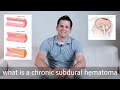 Chronic Subdural Hematoma