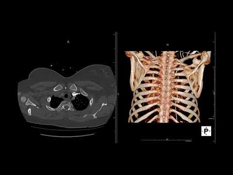 Anatomy - Chest CT