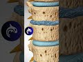 Degenerative Disc Disease - 4K 3D Animation