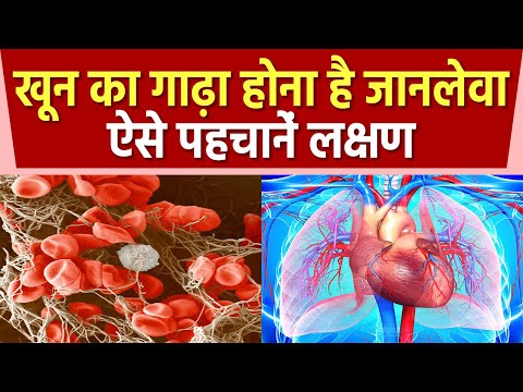 Blood के गाढ़ा होने से Health को होते है गंभीर नुकसान, जानिए लक्षण और ब्लड पतला करने के उपाय
