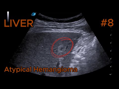 Atypical Hemangioma - Hyperechoic with Central Hypoechoic Core video preview