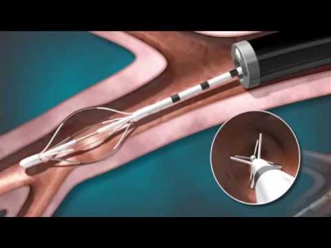 download lagu mp3 mp4 Herbal Tea For Asthma, download lagu Herbal Tea For Asthma gratis, unduh video klip Herbal Tea For Asthma