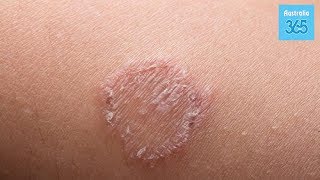 What is Ringworm, and How do we Treat It? - Australia 365