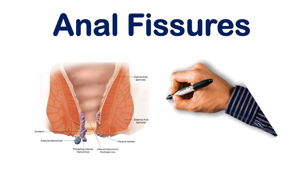 Anal fissures| USMLE Step, NCLEX, COMLEX - YouTube