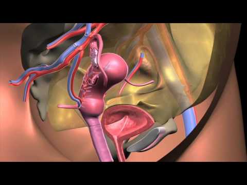 Uterus Transplant Animation Recipient