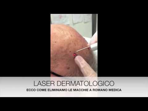 Il pigmentary nota lentigo come liberarsi Aceto di sidro di mela da pigmentazione su risposte di faccia