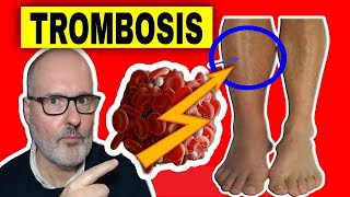 TROMBOSIS VENOSA PROFUNDA en las PIERNAS: causas, síntomas, prevención y tratamiento