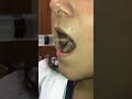 Irrigation Of Wisdom Tooth Sockets