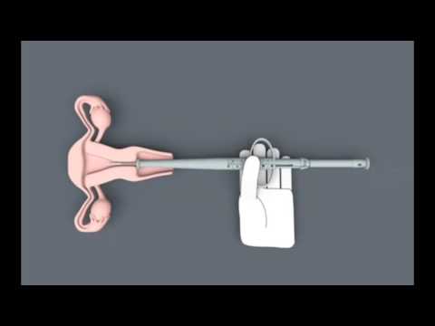 GOLD T® IUD – INSERTION SYSTEM
