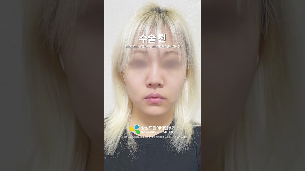 여자 비밸브 기능코성형 한달 후기🤞 #shorts  #비염수술 #비중격만곡증수술 #무보형물 #코성형 #남자코성형 #코성형브이로그 #코성형후기 #코성형전후 #비염 #비중격