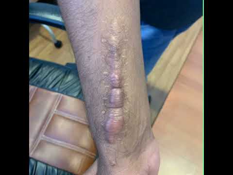 Keloid treatment before and after