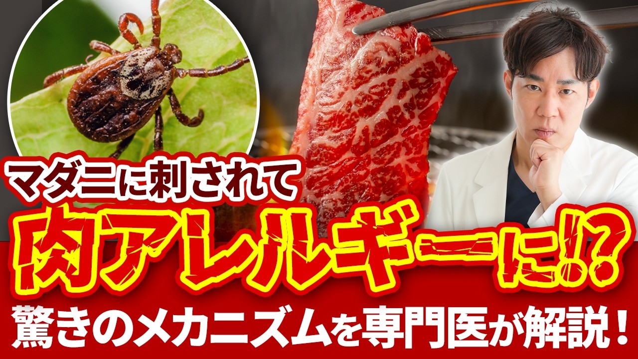 マダニに刺されると牛肉アレルギーに!? 『α-Gal症候群』を徹底解説！