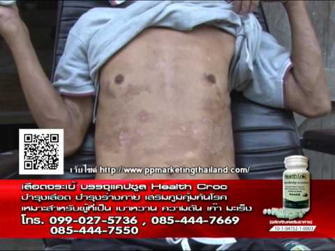 โรคสะเก็ดเงิน 1 จุด โรคสะเก็ดเงินและผลของมัน