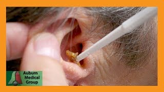 Dr. Gawayne Cleans Ears After Bell&#39;s Palsy | Auburn Medical Group