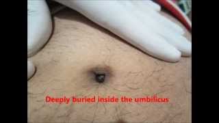 Clean Your Navel Belly (Umbilicus) Properly Or You may Face this In Your Belly Button