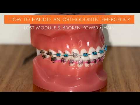 Handling An Orthodontic Emergency: Lost Module or Broken Power Chain