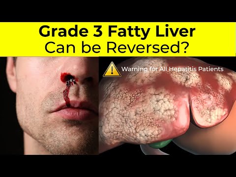 Fatty Liver Grade 3 Symptoms | Grade 3 Fatty Liver Treatment | Fatty Liver | Hepatitis