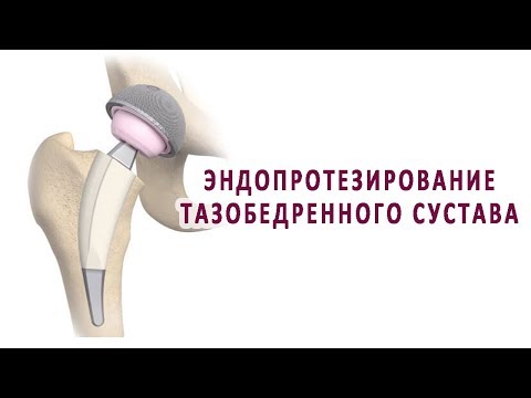 Современное лечение артроза коленного сустава От чего болит поясница при беременности на 21 неделе