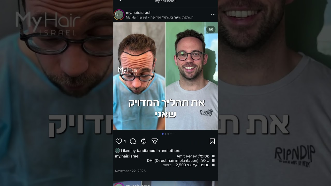 מהן השאלות שאתם חייבים לשאול לפני שאתם בוחרים מרפאת השתלת שיער?
