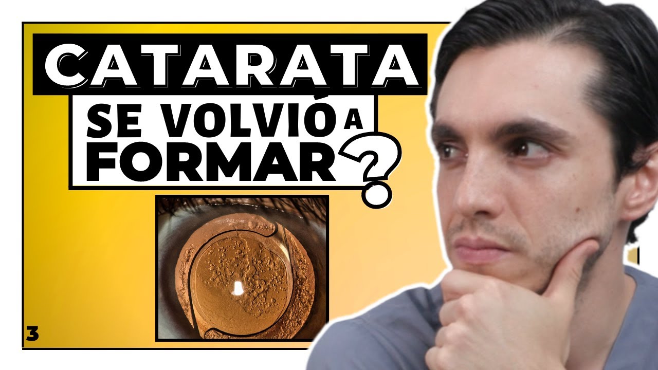 Watch Lente intraocular SUCIO 🤯 #1 Complicación en Cirugía de Catarata Now Lente intraocular SUCIO 🤯 #1 Complicación en Cirugía de Catarata