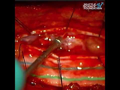 Thoracic Spinal Cord Meningioma - Live Surgery
