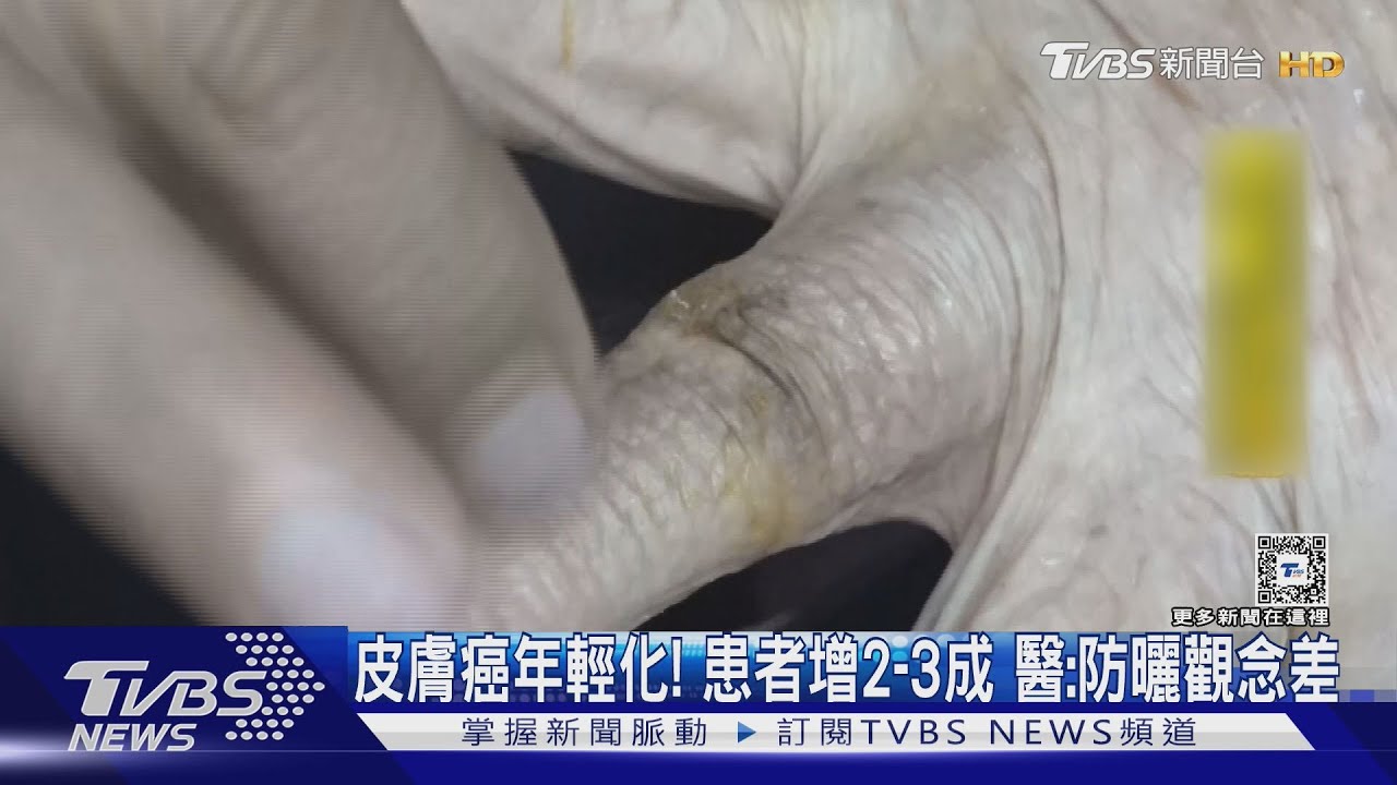 皮膚癌年輕化！患者增2到3成　醫：防曬觀念差